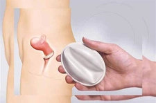 Diyafram Doğum Kontrol Avantajları Diyafram Doğum Kontrol Avantajları