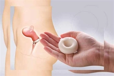 Doğum Kontrol Diyafram Nedir? Doğum Kontrol Diyafram Nedir?