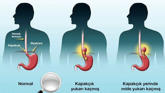 Diyafram Hastalıkları Belirtileri ve Tedavisi